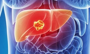 Câncer no fígado: Saiba mais sobre a técnica de quimioembolização hepática