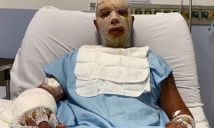 Prefeito e esposa feridos na explosão de fogueira por pouco não ficaram cegos