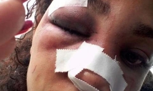 Com ciúme, homem quebra nariz de ex-mulher na frente da filha de 2 anos
