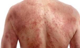 Dermatite atópica é crônica e incurável, mas pode ser controlada