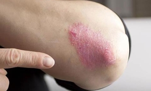 Dia mundial da Psoríase: especialista alerta que doença não é contagiosa