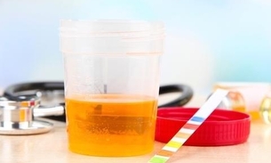 Hematúria: sangue na urina pede investigação clínica especializada
