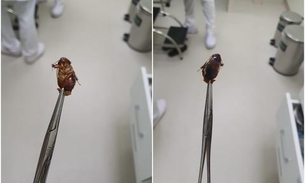 Barata ainda viva é retirada de ouvido de mulher 