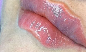 Novo procedimento estético 'Boca do Diabo’ vira febre mundial  