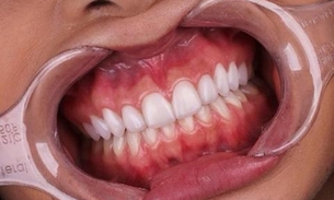 Saiba tudo sobre as famosas 'Lentes de Contato Dentais’