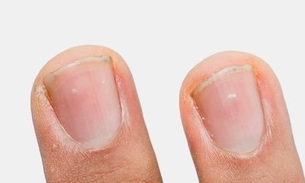 Veja o que pode ser mancha branca na unha e como tratar