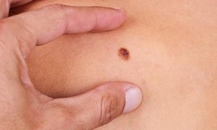 Campanha de prevenção do câncer de pele identifica 4 mil casos no Brasil