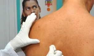 'Janeiro Roxo': Manaus ganha ações de combate à hanseníase; Confira programação