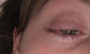 Jovem quase perde a visão ao fazer extensão de cílios 