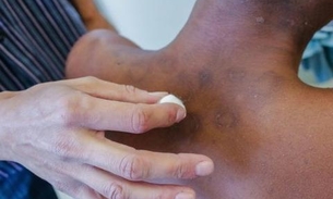 Hanseníase: conheça os sintomas e o tratamento para a doença