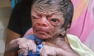 Bebê nasce com aparência de idoso e é comparado a Benjamin Button