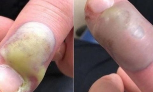 Homem quase morre após contrair infecção por roer unhas