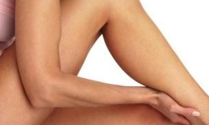 Especialista ensina como tratar varizes sem cirurgia