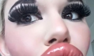 Jovem choca com aparência após fazer 20 procedimentos de preenchimento labial 