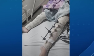 Médicos se confundem e menina de 6 anos tem pinos colocados em perna errada