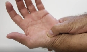 Lúpus é uma doença autoimune crônica que pode causar inflamação e dor - Foto: Agência Brasil