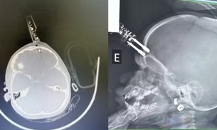 Menina fica com carregador cravado na cabeça em MG — Foto: Bruno Castro/Arquivo Pessoal