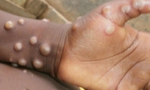 Casos de varíola dos macacos / Foto ilustrativa: OMS/Nigeria Center for Disease Control
