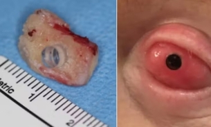 Brent se submeteu a implante de um dente num dos seus olhos - Foto: Reprodução