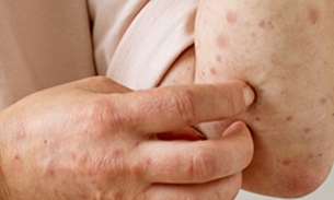 Mpox - Foto: Divulgação Governo