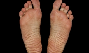 Especialista desmistifica os principais mitos sobre dores nos pés