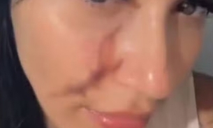 Carla foi atacada no rosto - Foto: Arquivo pessoal 