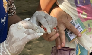 Exame de malária - Foto: Divulgação 