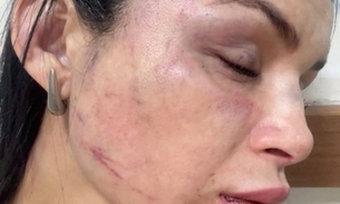 Márcia mostrou os hematomas - Foto: Divulgação 