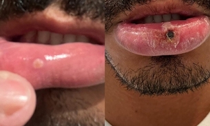 Imagem mostra a evolução da ferida no lábio de João / Foto: Reprodução/Twitter/João Pinheiro