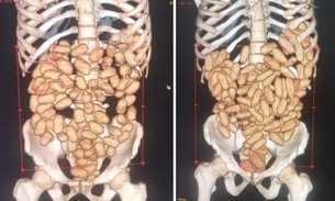 Exames de raio-x mostram cápsulas com cocaína dentro dos estômagos de estrangeiros — Foto: Divulgação