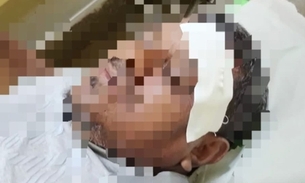 Vereador sofre acidente com motocicleta em Maués