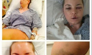 Atriz pornô fala sobre momentos de terror e mostra lesões 