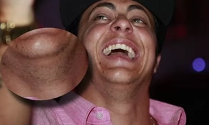  Thammy Miranda começa a ter barba após retirar seios