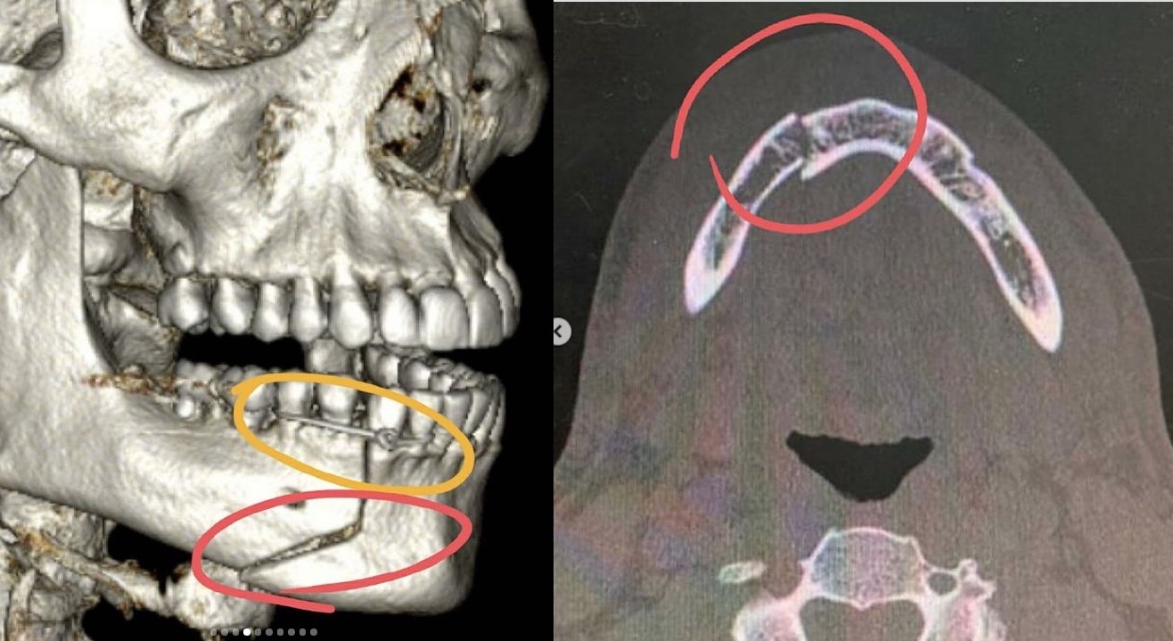 Mandíbula quebrada 