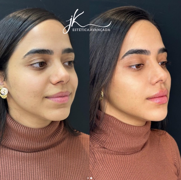 Antes e depois Mariely - Foto: Reprodução/Instagram Jk Estética Avançada 