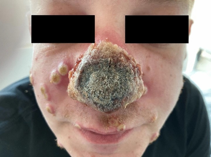 Foto: Infection/Springer Nature/Divulgação