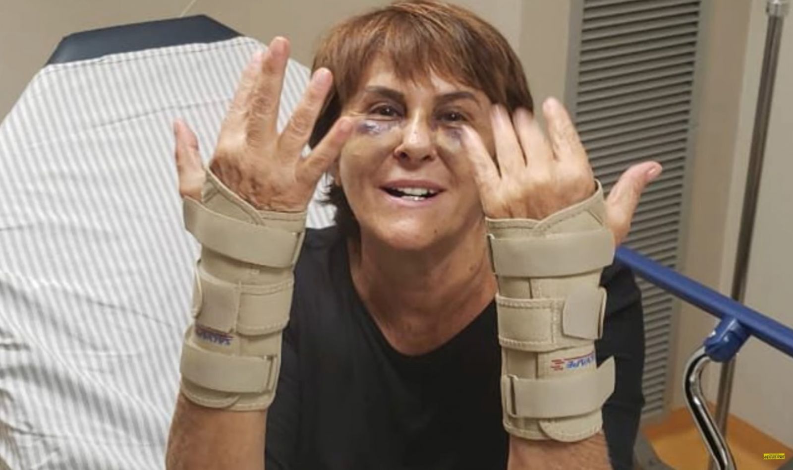 Márcia mostrou foto das fraturas. Foto: YouTube.