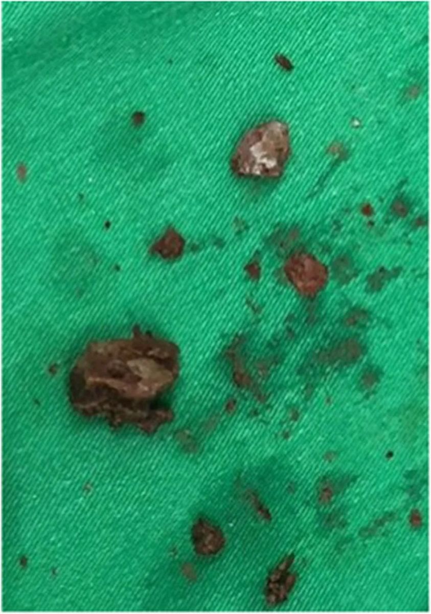 Fragmentos de pedra do tamanho de 'laranja' que foi removida de mulher no Líbano — Foto: Reprodução / Urology Case Reports