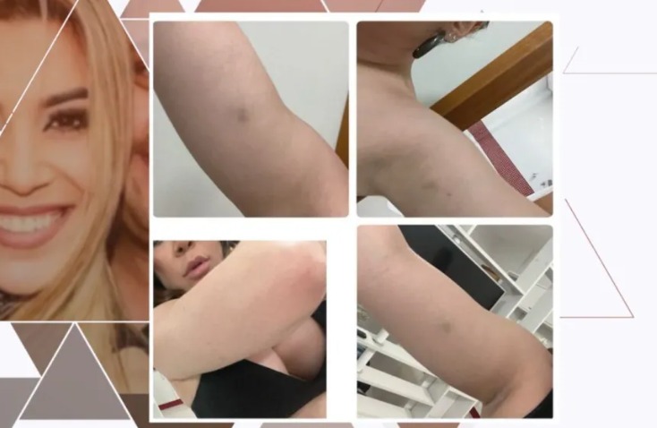 Cantora mostrou hematomas pelo corpo - Imagens: Reprodução/TV Globo