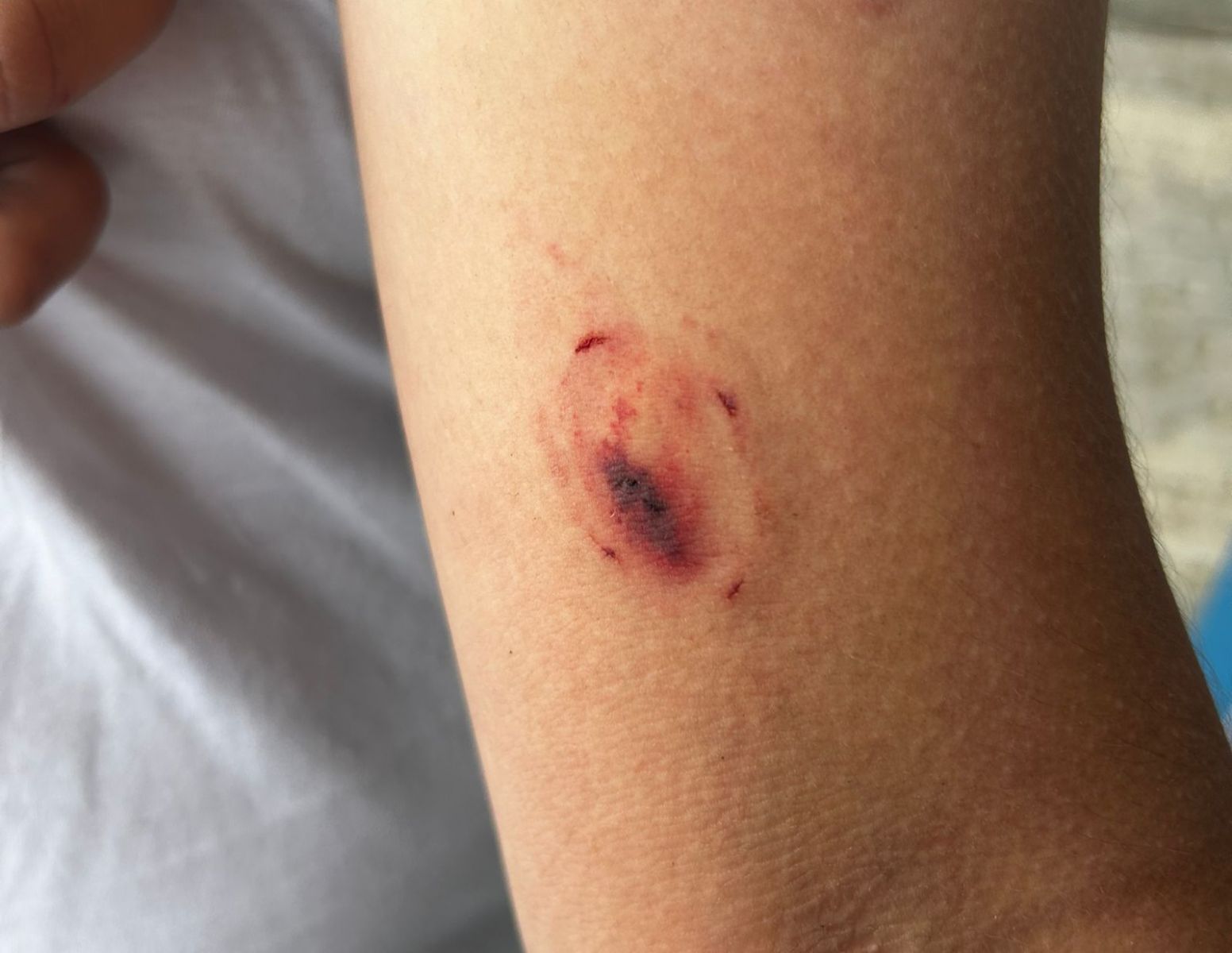 Primo mostra mordidas -  Foto: Jander Robson/Portal do Holanda