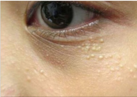saiba-como-acabar-de-vez-com-milias-bolinhas-que-surgem-ao-redor-dos-olhos